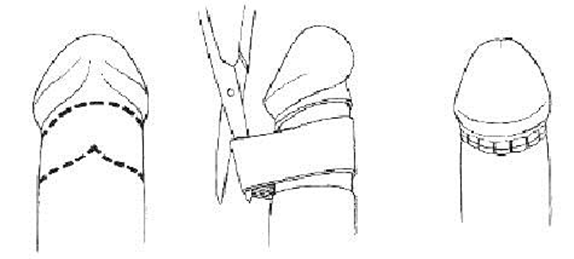 Adjusting the frenulum length, and tightening up the outer ring. Figure...  | Download Scientific Diagram